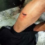 पारस नगर में चाकूबाजी, पुरानी रंजिश में युवक पर जानलेवा हमला; दो आरोपी गिरफ्तार