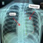 अम्बेडकर अस्पताल में 11 साल के बच्चे के दिल से चिपका दुर्लभ कैंसर निकाला, बना विश्व कीर्तिमान