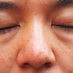 Face पर सूजन क्या है, यह कैसे होती है और इसे कम करने के लिए क्या करें