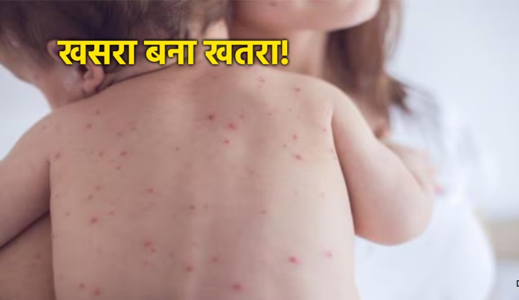 ग्वालियर में ‘खसरे’ का खौफ: अस्पताल में भर्ती हुए 8 मासूम, एक की रिपोर्ट पॉजिटिव आने से मचा हड़कंप; संक्रमण फैलने का खतरा