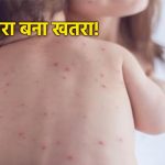 ग्वालियर में ‘खसरे’ का खौफ: अस्पताल में भर्ती हुए 8 मासूम, एक की रिपोर्ट पॉजिटिव आने से मचा हड़कंप; संक्रमण फैलने का खतरा