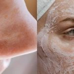 10 रुपये में पाएं Smooth skin ओपन पोर्स के लिए असरदार फेस पैक