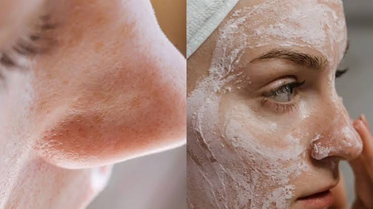 10 रुपये में पाएं Smooth skin ओपन पोर्स के लिए असरदार फेस पैक